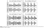 Sex-related Differences in Loop Gain during High-Altitude Sleep-disordered Breathing